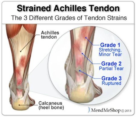 Achilles tendon rupture