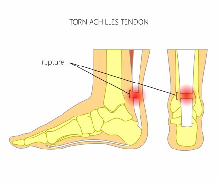Achilles tendon rupture