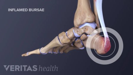 Achilles tendon rupture