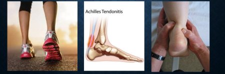 Achilles tendonitis