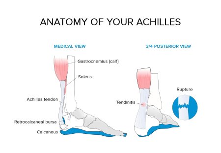 Achilles tendinitis