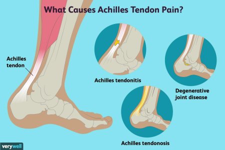 Achilles tendonitis