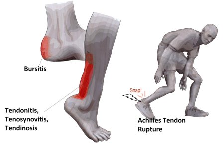 Achilles tendon rupture