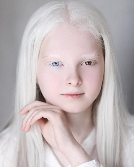 Амина эпендиева альбинос